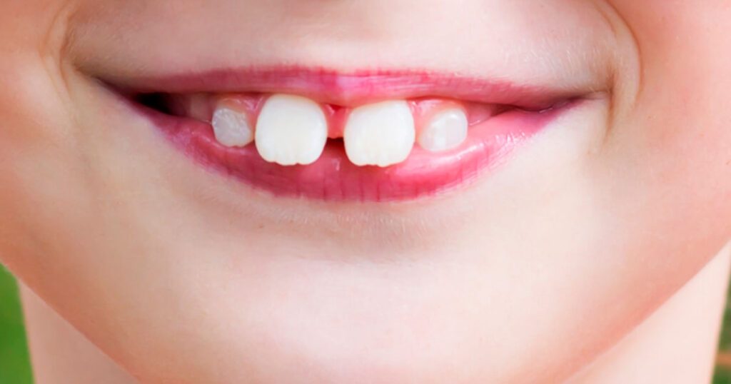 PABIJ Aragón: salud bucodental gratuita para niños de 6 a 14 años